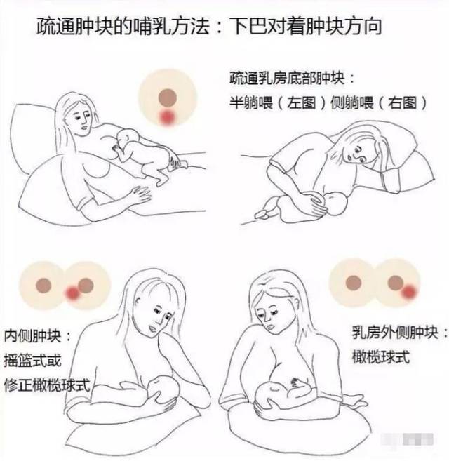 產(chǎn)后漲奶，疼痛難忍怎么辦？